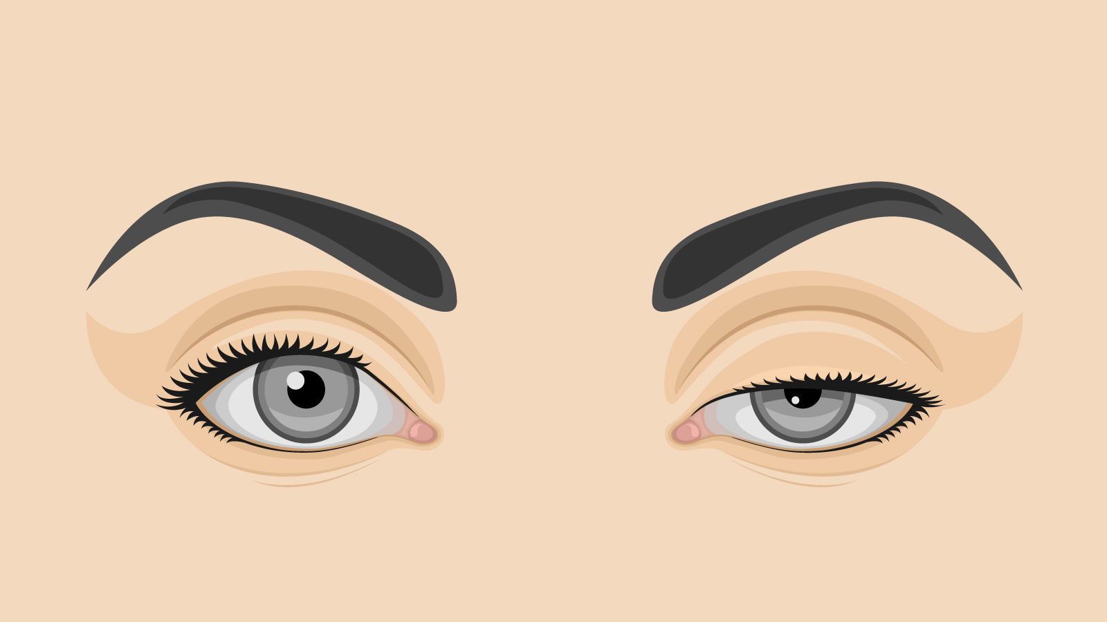 Ptosis – Important know-how of lazy eye condition
